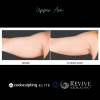CoolSculpting® Elite Upper Arm 