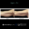 CoolSculpting® Elite Upper Arm 