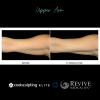 CoolSculpting® Elite Upper Arm 
