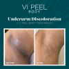 VI Peel Body