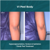 VI Peel Body