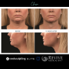 CoolSculpting® Elite Chin