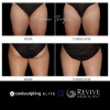 CoolSculpting® Elite Thighs
