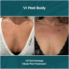 VI Peel Body