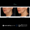 CoolSculpting® Elite Chin