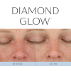DiamondGlow + Dermaplane