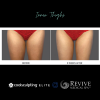 CoolSculpting® Elite Thighs
