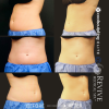 CoolSculpting® - Elite Midsection Makeover