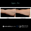 CoolSculpting® Elite Upper Arm 