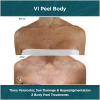 VI Peel Body