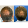 KeraLase Hair Restoration 