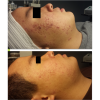 Celluma LED Light Therapy - Facial Add-On