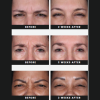 Daxxify Before and After