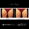 CoolSculpting® Elite Thighs