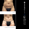 CoolSculpting® - Elite Midsection Makeover