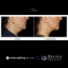 CoolSculpting® Elite Chin