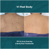 VI Peel Body