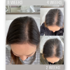KeraLase Hair Restoration 