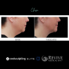 CoolSculpting® Elite Chin
