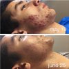 Celluma LED Light Therapy - Facial Add-On