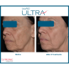 Lutronic Ultra™