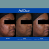 AviClear
