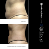 CoolSculpting® - Elite Midsection Makeover