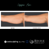 CoolSculpting® Elite Upper Arm 
