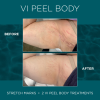 VI Peel Body