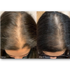 KeraLase Hair Restoration 
