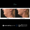 CoolSculpting® Elite Chin