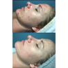 Celluma LED Light Therapy - Facial Add-On