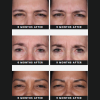 Daxxify Before and After 9 months
