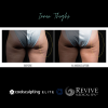 CoolSculpting® Elite Thighs