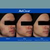 AviClear