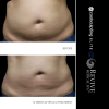 CoolSculpting® - Elite Midsection Makeover