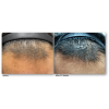 KeraLase Hair Restoration 