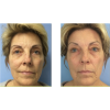 Celluma LED Light Therapy - Facial Add-On