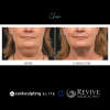 CoolSculpting® Elite Chin