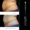 CoolSculpting® - Elite Midsection Makeover