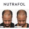 Nutrafol before and growing 3-months