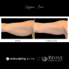 CoolSculpting® Elite Upper Arm 