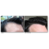 KeraLase Hair Restoration 