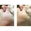 Celluma LED Light Therapy - Facial Add-On