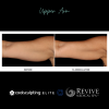 CoolSculpting® Elite Upper Arm 