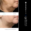 CoolSculpting® Elite Chin