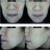 DermaV