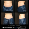 CoolSculpting® - Elite Midsection Makeover