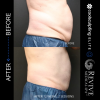 CoolSculpting® - Elite Midsection Makeover