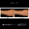 CoolSculpting® Elite Upper Arm 